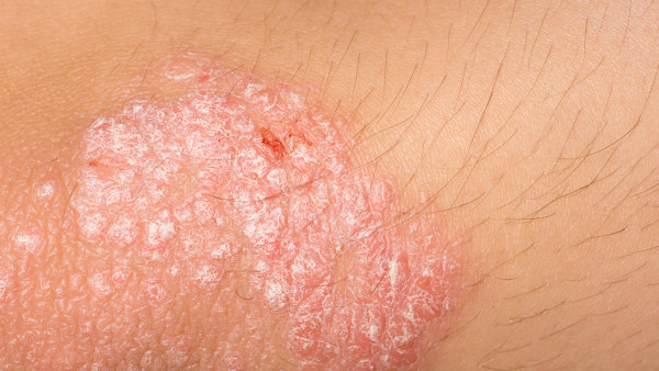 临床上银屑病和剥脱性皮炎损害有什么不同呢? 